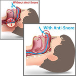 Anti Snore Device (SNORE RELIEF) Snore Relief Blue / with retail box